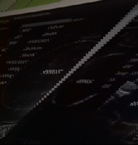 bun mau tanya. ini saya habis usg. tapi gak bisa cara bacanya. mohon bantuannya bun🙏