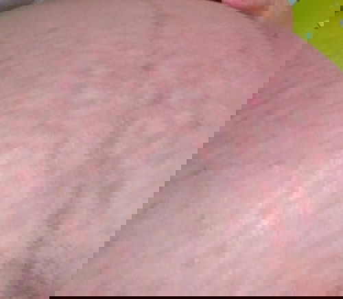 Perut merah merah dan gatal usia kandungan 38week