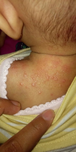 Udah seminggu kulit bayiku bintik-bintik merah gini kayak makin banyak..