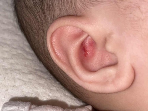 Newborn ear bleeding