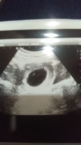 Apa kehamilan BO bisa dinusahakan untuk normal , aku habis usg tapi hasilnya sangat membuat sedih .