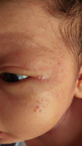 Bintik putih merah di wajah dan leher