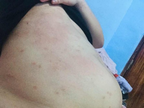 Puppp Rash in first trimester