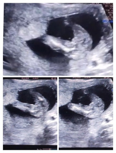 Nak tanya mommy2 baby girl or boy?16 week..