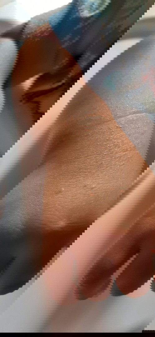 Bruntusan biang keringat