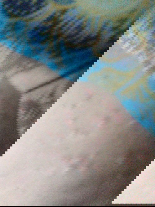 Streak mark Dan ruam