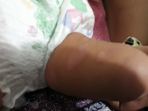 Bercak putih di paha