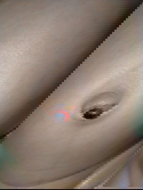 granuloma umbilikalis