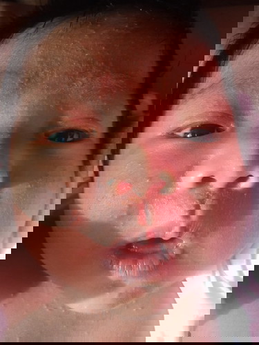 rashes sa mukha ni Lo