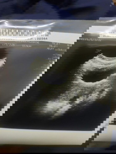 อัลตร้าซาว์ไม่พบการตั้งครรภ์