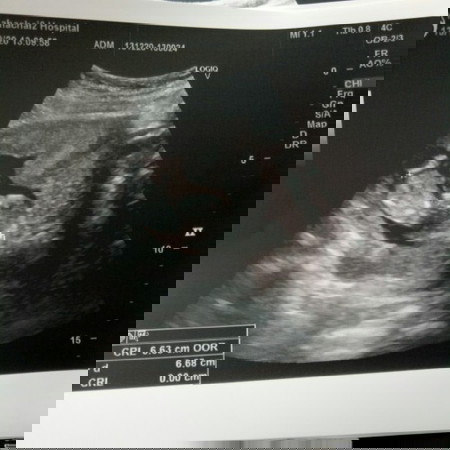 ในแอพ13วีคต้องยาว7ซม.หนัก22กรัมแล้วแต่ซาวน์มาเมื่อวานยาวแค่6.6cm17gmหมอบอกโตตามเกณฑ์ แต่ก็แอบกังวล