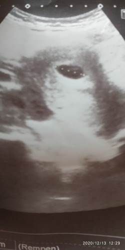 nak tnya mummy2 smua..nrmal ke scan 6w6d nmpk kantung saja..