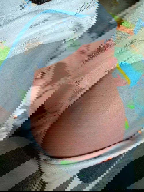 หลังน้องเป็นตุ่มแบบนี้ค่ะ ทำยังไงดีคะแนะนำหน่อยค่ะ น้องพึ่งคลอดได้ 13 วัน