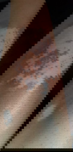 My skin is hyperpigmented