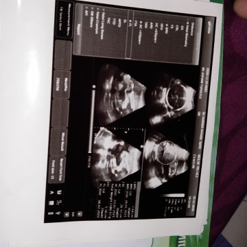 Saya bingung sma dokter saya hpht april 19 uda selesai haid eh hal saya 28 januari si mana bisa.