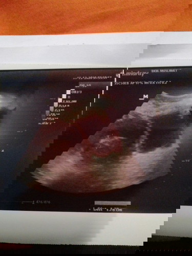 Hasil USG dan Trauma