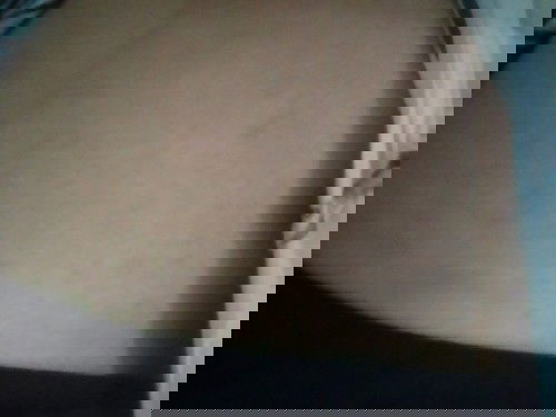 Kaki bengkak, area perut dan payudara muncul bintik. Knp?