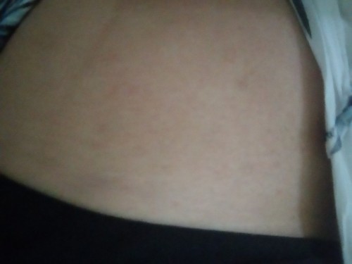 Kaki bengkak, area perut dan payudara muncul bintik. Knp?