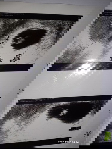 Mom's aku mau tanya nih, aku sdh masuk usia kehamilan 8w tp pas usg sdh ada janin kecil tp gaadaDJ?