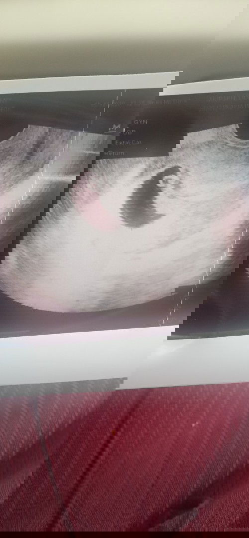 Usia kehamilan 8 minggu hanya yolksac yang terlihat