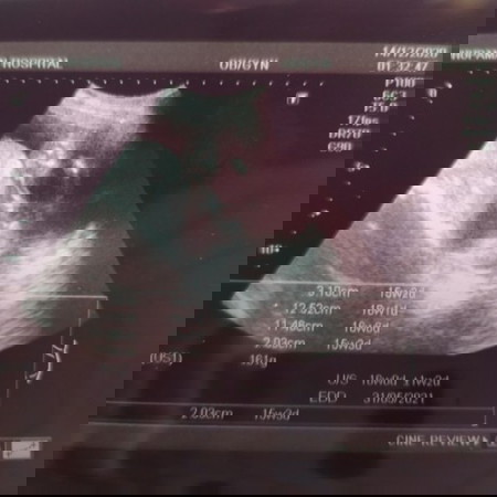 เพศลูกและน้ำหนัก