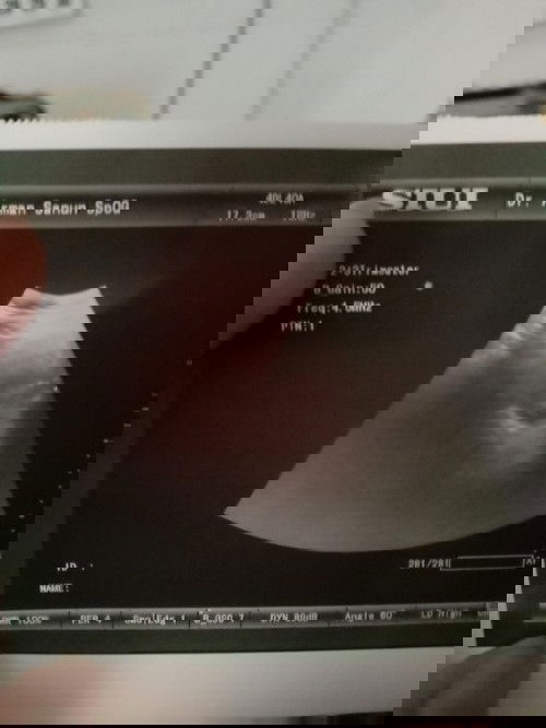 Pendarahan seperti menstruasi tapi di usg masih ada kantung dan masih aman