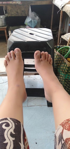 Kaki bengkak
