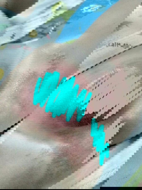 Bintik Kemerahan pada kemaluan bayi laki-laki