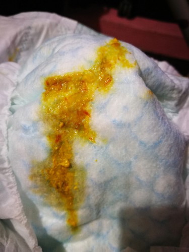 Streaks of blood in baby's poop