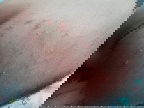 ทารก 2 เดืิอน เป็นตุ่มคล้ายสิวที่หน้าผากเยอะมาก ๆ