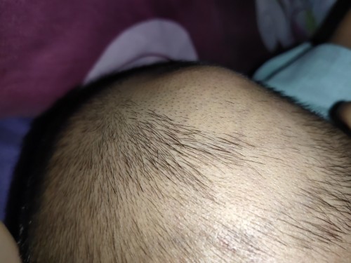 Ini benjolan apa y? Tdk kenyal atwpun keras saat ditekan. Si anak jg tdk kesakitan. Mohon share bund