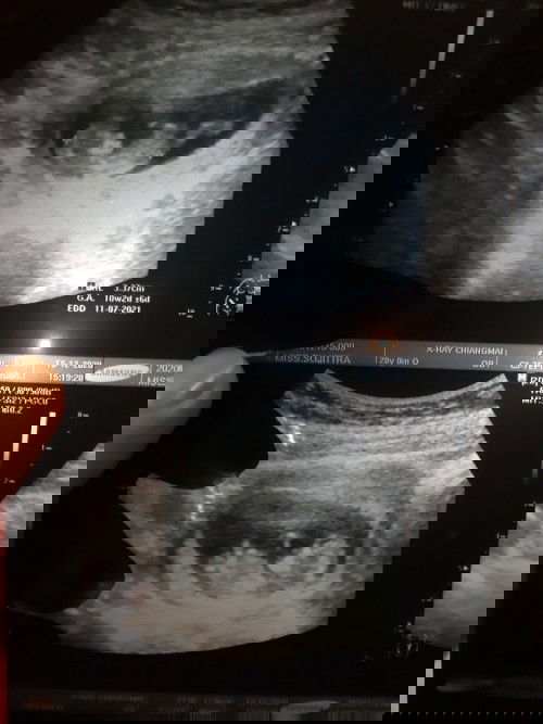 10 week +5 เพิ่งซาวด์ครั้งแรก