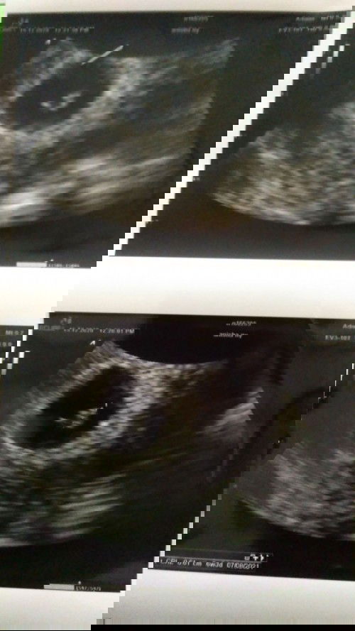 Flek di kehamilan 6 minggu lebih