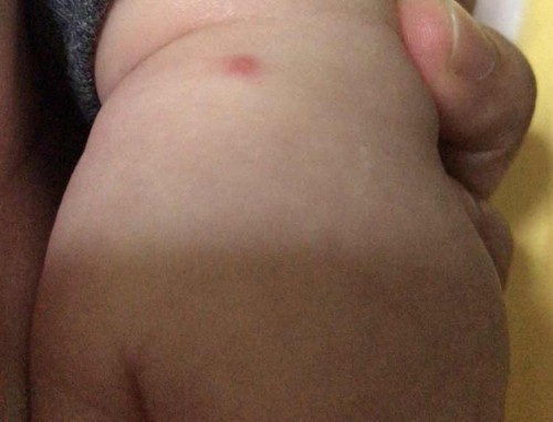 Red spots on baby