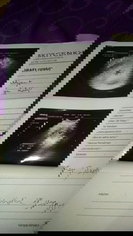 Hasil USG umur 5w5d