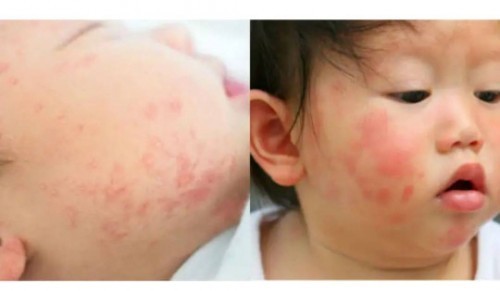 เป็นผื่นแดงตามใบหน้า หู และศรีษะ พอมีวิธีรักษาไหมครับ อาการตามภาพเลยครับ