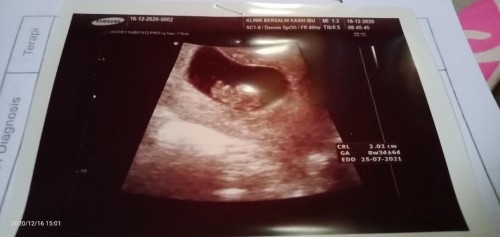 Umur kehamilan 8 minggu, ukuran 2,2 cm, detak jantungnya keras banget,, adakah yang sama bunda??????