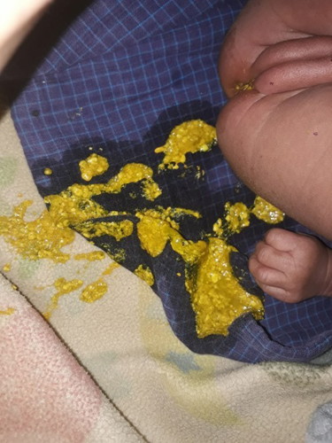 Watery poop in newborn