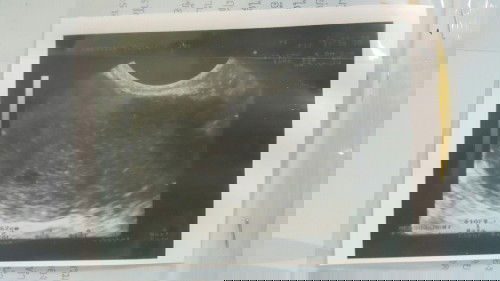 หลังจากที่แท้งไปเมื่อปีที่แล้ว ปีนี้ตรวจเจอสองขีด ตั้งครรภ์ประมาณ 5 week
แต่ซาวค์ยังไม่เจอถุงเลย