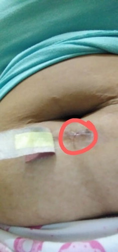 ทำหมันแล้ว แต่ไหมละลายที่หมอเย็บไว้ยังหลุดไม่หมด อันตรายมั๊ยคะ ใครรู้ช่วยบอกที😢😢😢😢😢😢😢😢😢😢😢