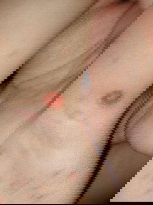 Masalah kulit d bhgian ketiak anak sy. Ada yg pernah mengalami keadaan sprti ni?