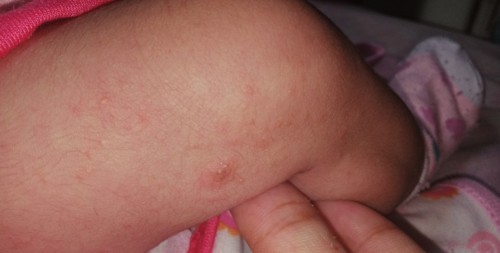 Baby rashes