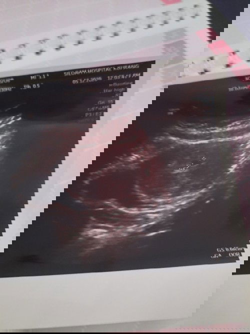 Pernah BO 2x, istirahat rahim 1th, sekarang lagi hamil... tapi masih deg-degan :(