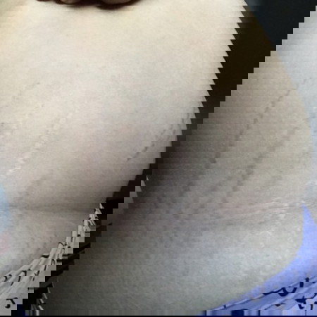 ท้องแตกลาย ยังไงก็ไม่หายใช่มั้ยคะ