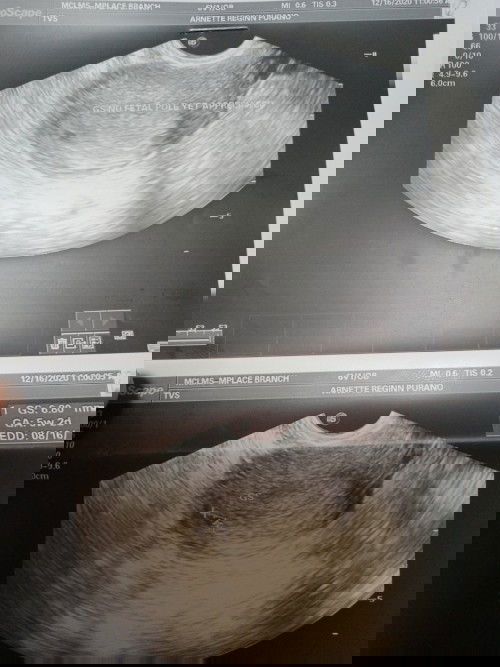 Is it normal po? 5wks  palang kya no fetal pole pa ? Nag aanxiety po ako ndi pa nbbasa ng OBI ko .