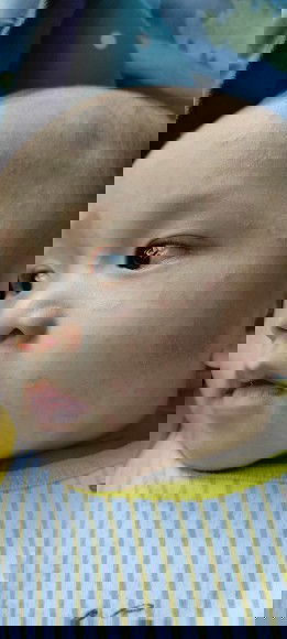 Bayi gatal merah sekujur tubuh