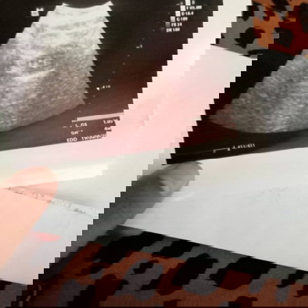 Bun aku hamil baru 5weeks ,kadang ada sedikit sakit perut Kiri/kanan trus smbuh lagi apa bunda sama