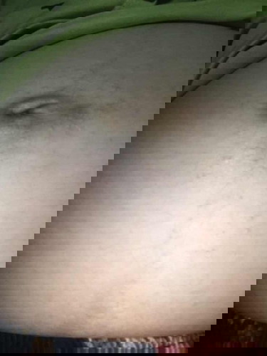 Hi mga Mommies! Normal po ba ang magkaroon ng butlig sa baby bump?