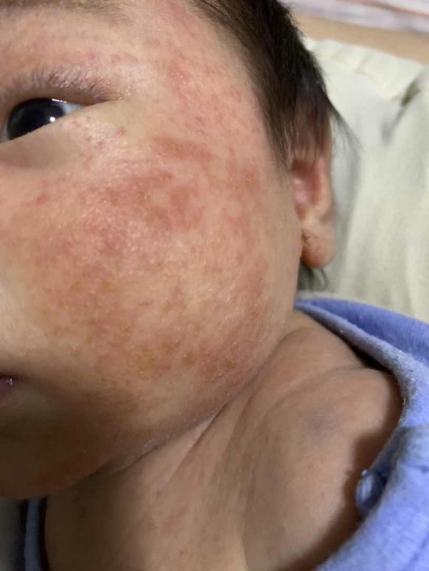 Baby rashes Hi mommies, normal lang ba rashes ni baby sa fac