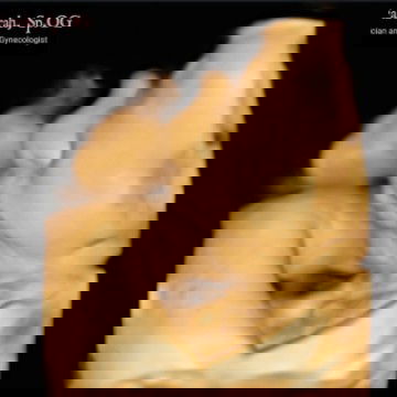 Bayi terlilit tali pusar 2 lilitan